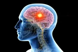 این نشانههای ساده میتوانند به تومور مغزی مربوط باشند