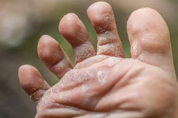 پوستهپوسته شدن پا نشانه چیست؟؛ ۱۰ علت شایع و راههای پیشگیری