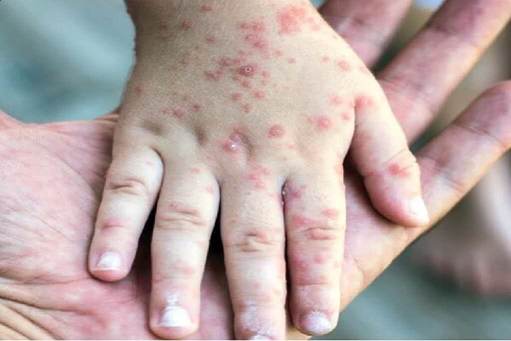 سرخک یکی از مسری ترین بیماری ها؛ این فیلم را ببینید